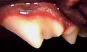 Stage 1 Teeth